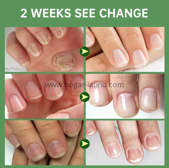 Base Uñas 4K Potente🙅‍♀️ Crecimiento & Hongos AVANZADO 300% (COMPRA 1 & LLEVA 2)